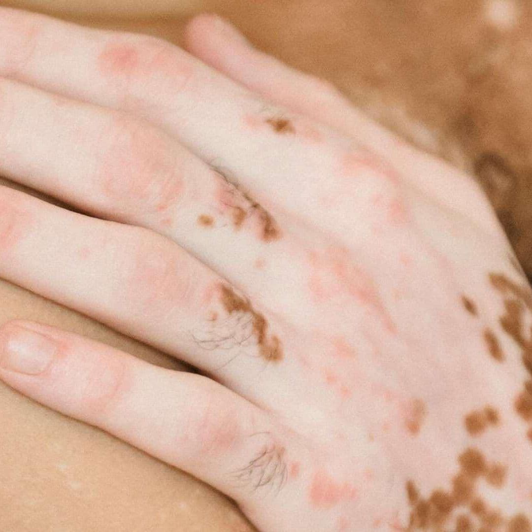 Día Mundial del Vitíligo: Enfermedad que Provoca Discriminación